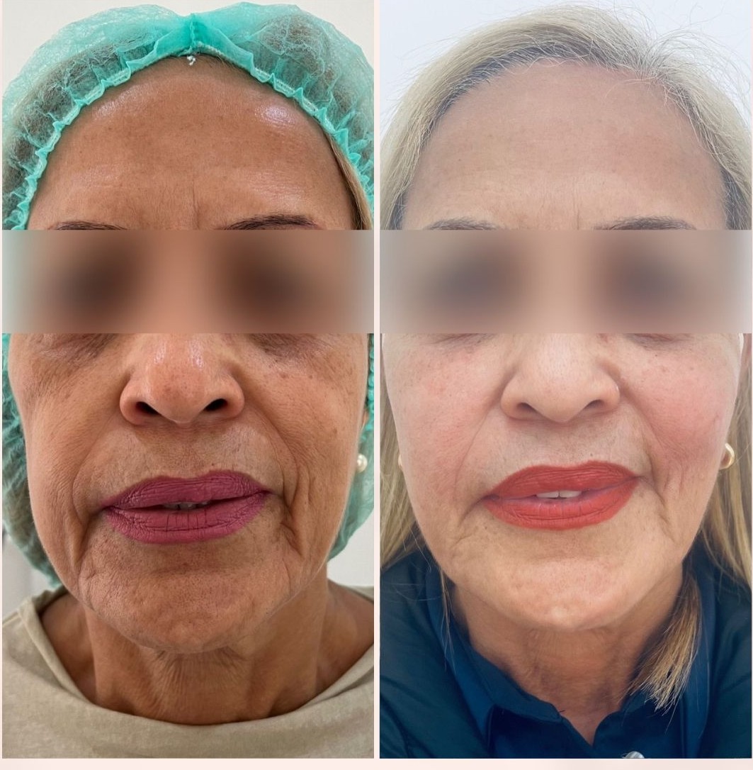 Antes y después: Full Face — armonización facial completa