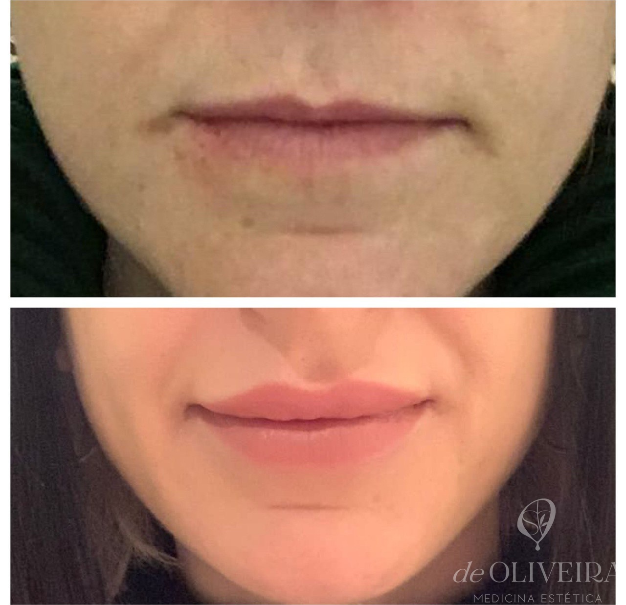 Resultado antes y después de un tratamiento de labios