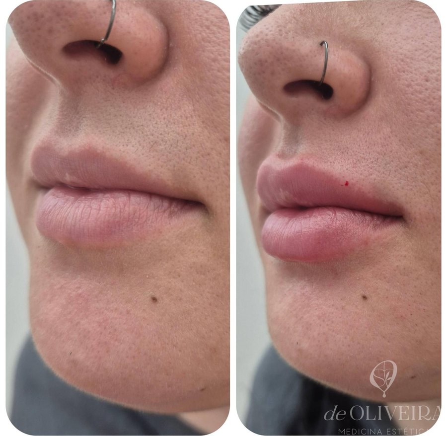 Antes y después: Labios — volumen y definición del contorno