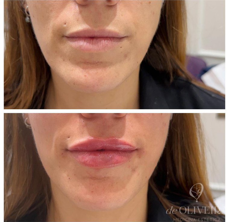 Antes y después: Labios — resultado natural, respetando la proporción