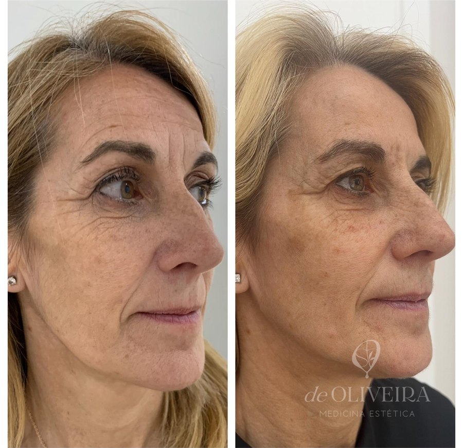 Antes y después: Full Face — rostro más descansado y armónico