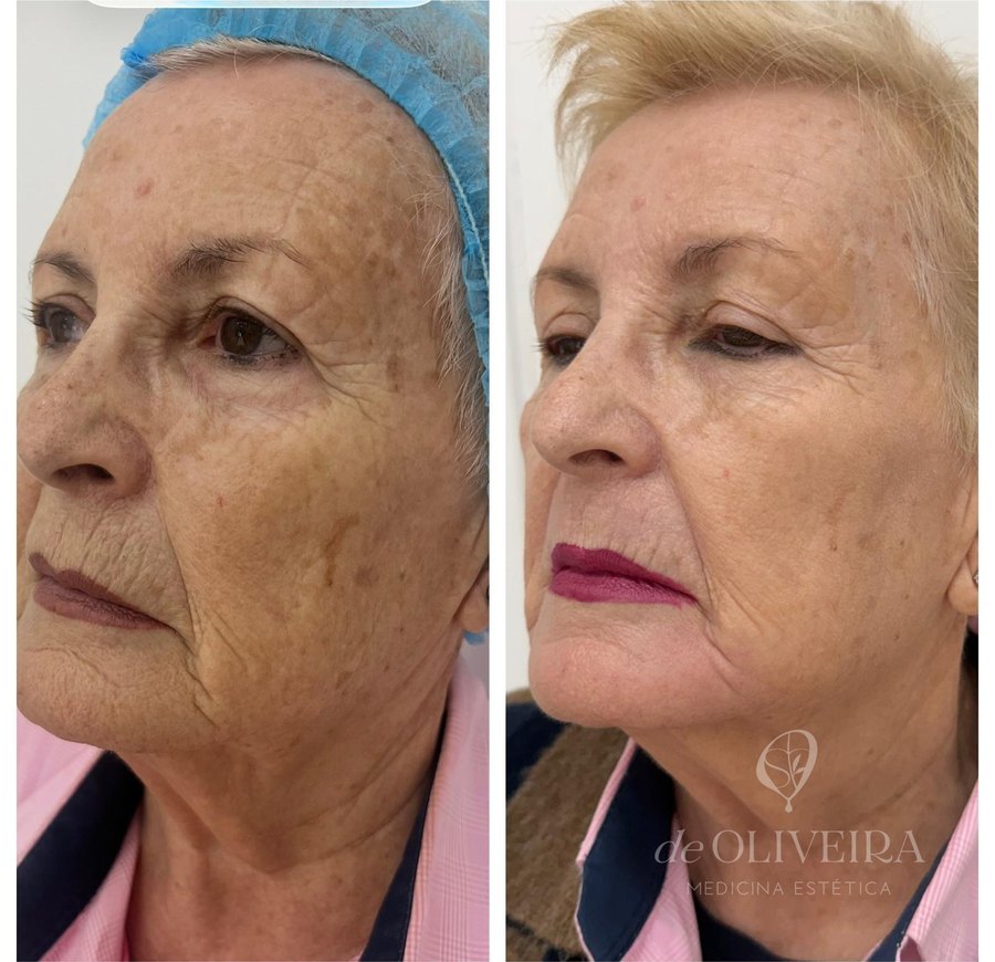 Antes y después: Full Face — sostén y frescura del rostro