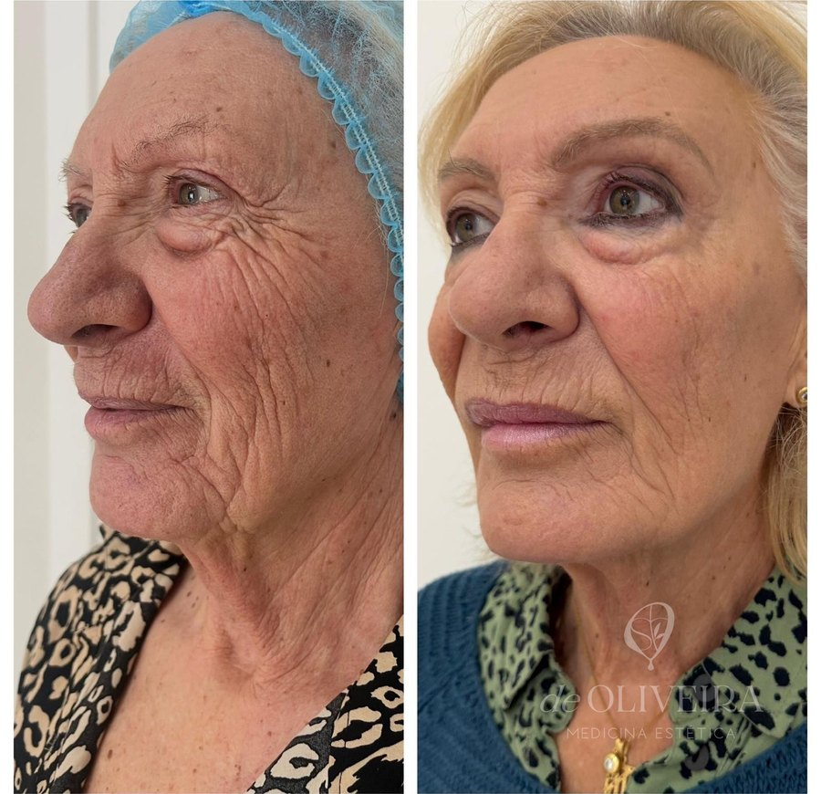 Antes y después: Full Face — armonización global del rostro