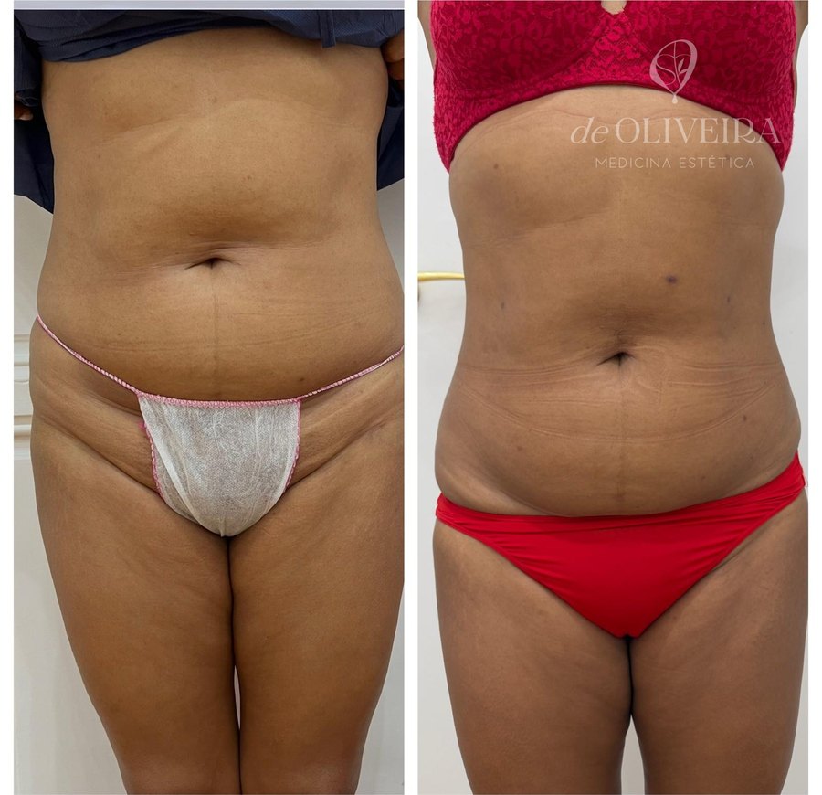 Antes y después: Lipoláser — reducción de grasa localizada en abdomen