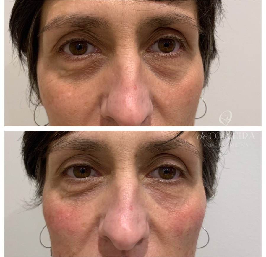 Antes y después: Ojeras — relleno con ácido hialurónico