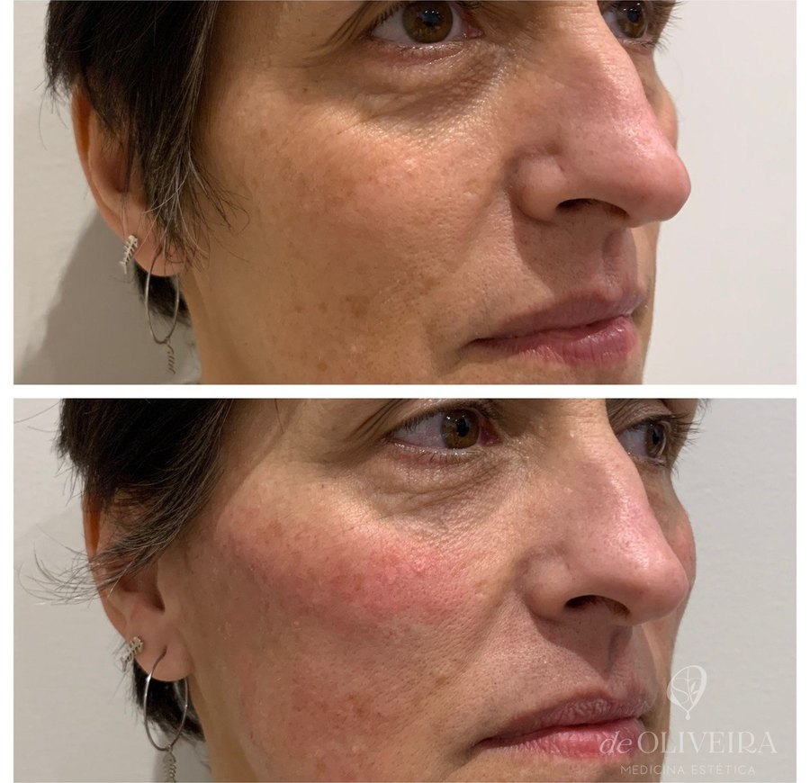 Antes y después: Ojeras — una mirada más descansada