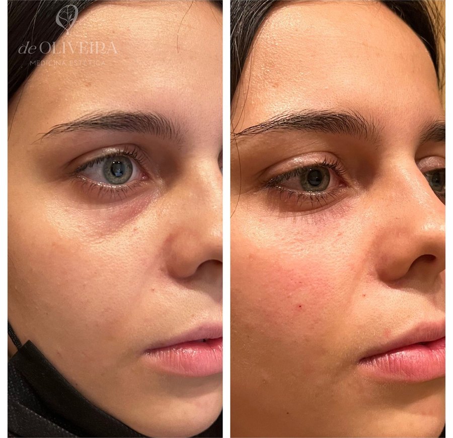Antes y después: Ojeras — se rellena el surco de la ojera