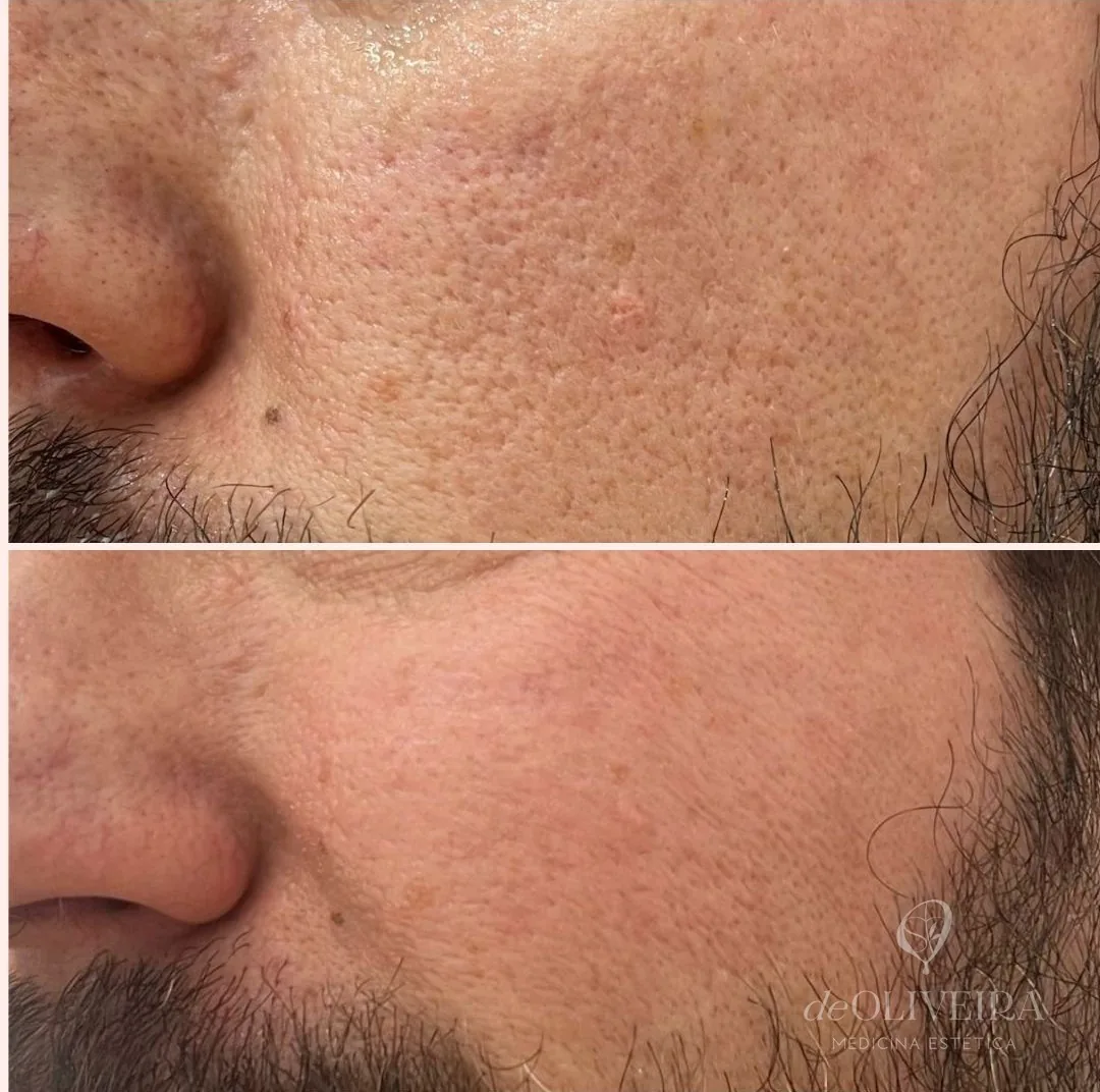 Antes y después de poros y textura de la piel, en deOLIVEIRA | Clinic