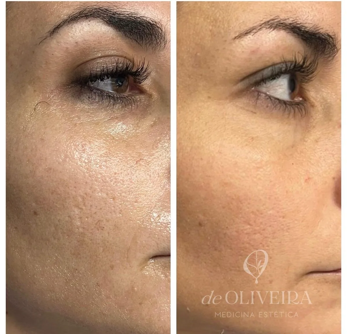 Antes y después de marcas y textura en la mejilla, en deOLIVEIRA | Clinic