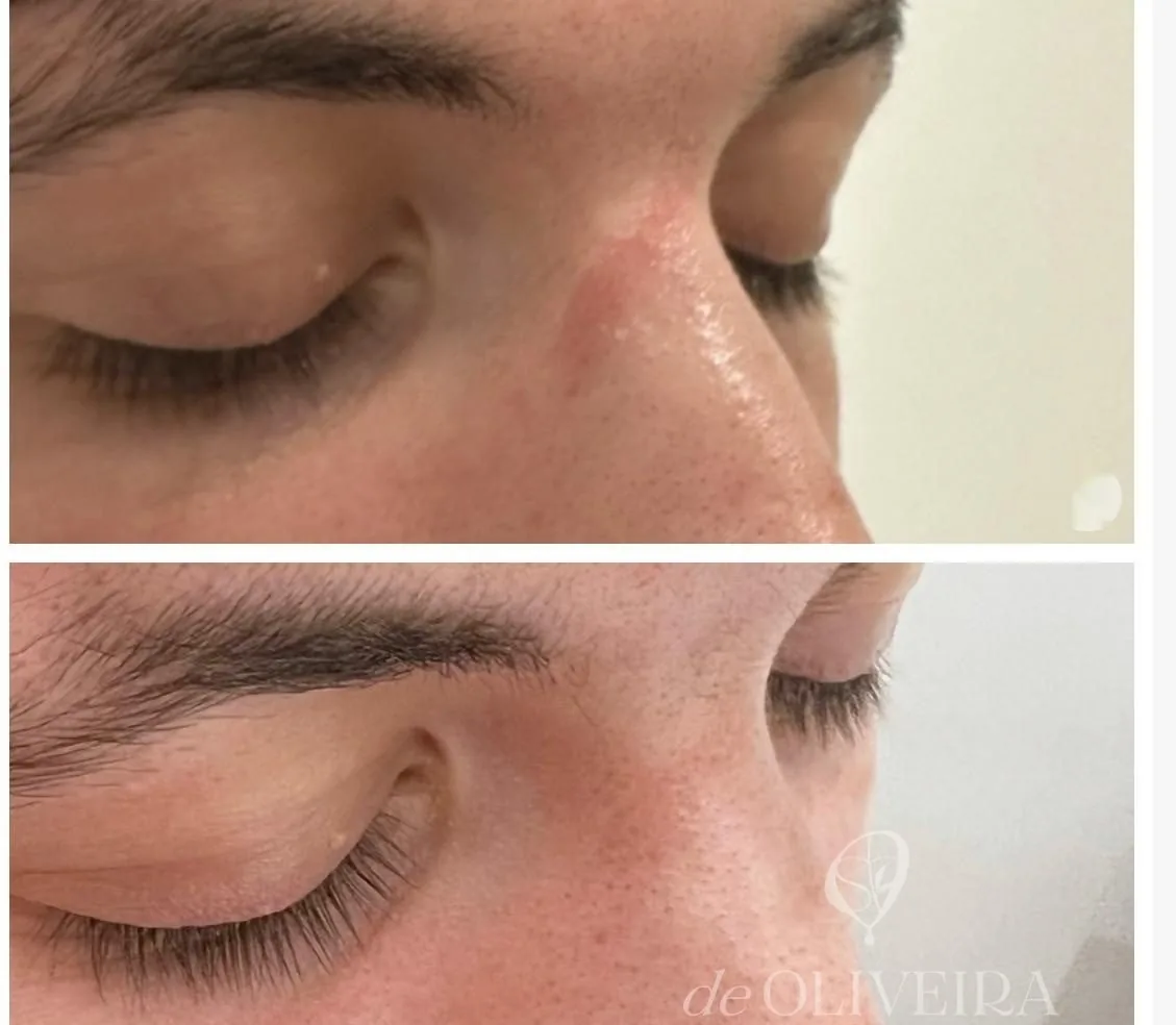 Antes y después de una cicatriz en la nariz, en deOLIVEIRA | Clinic