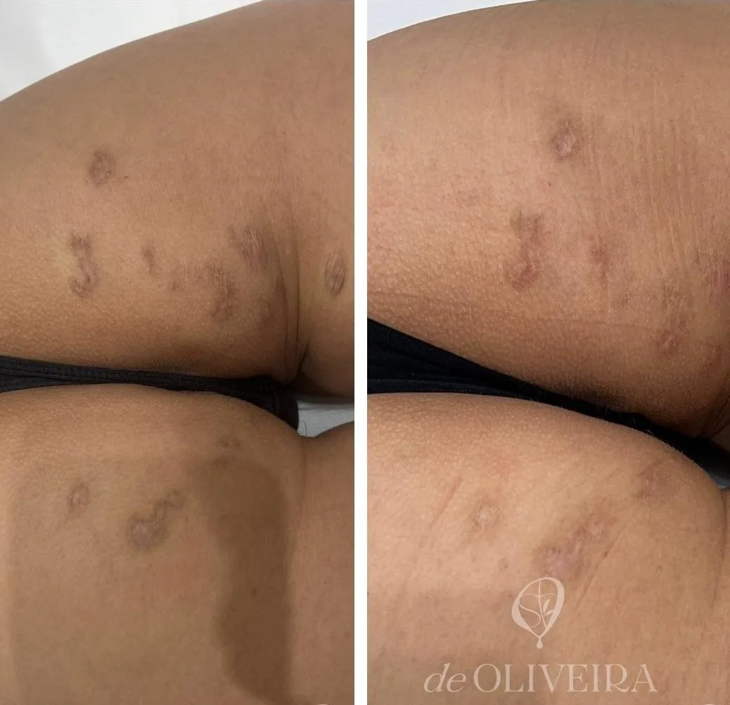 Antes y después de una cicatriz quirúrgica, en deOLIVEIRA | Clinic