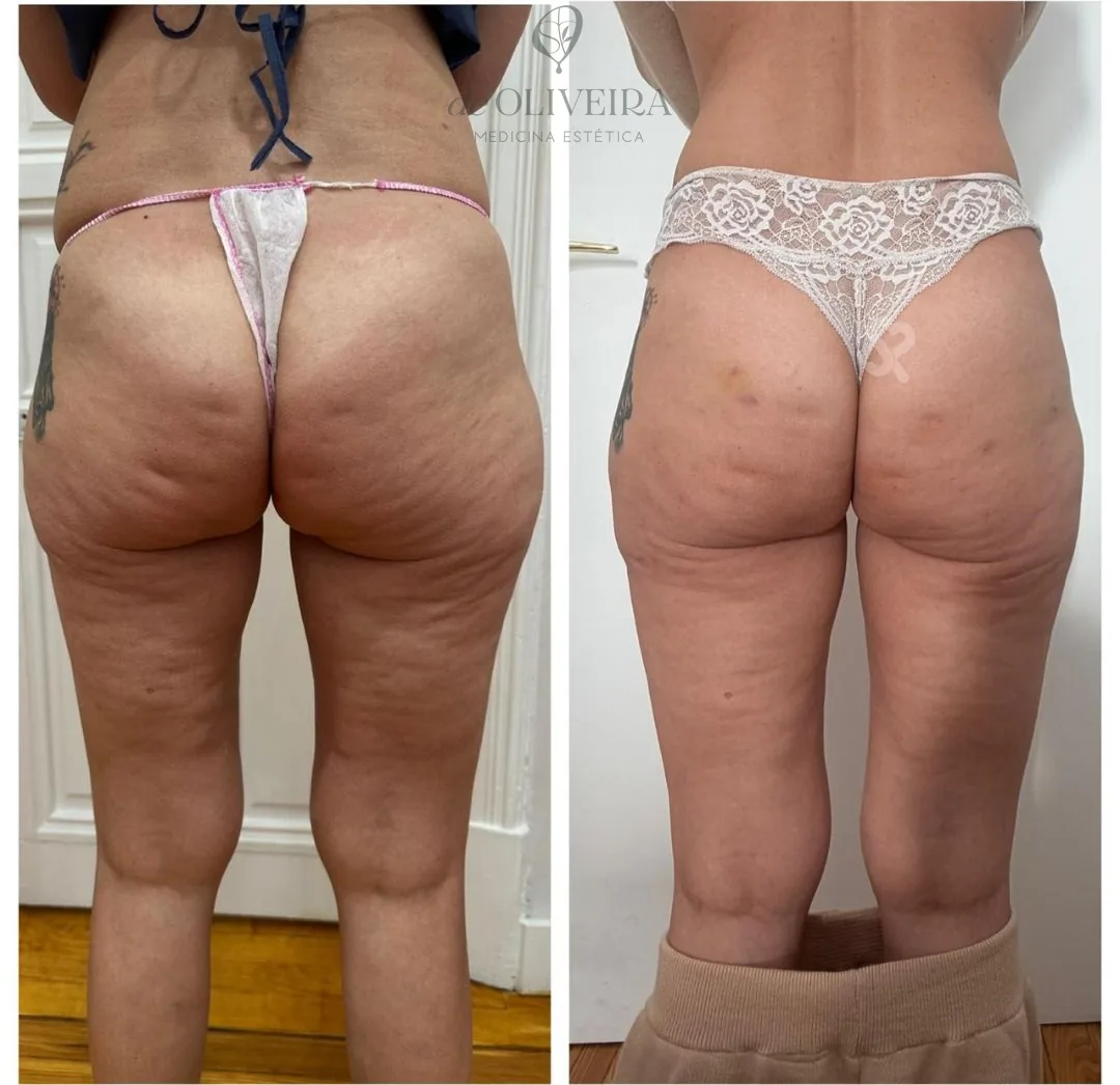 Antes y después en glúteos, en deOLIVEIRA | Clinic (Madrid)
