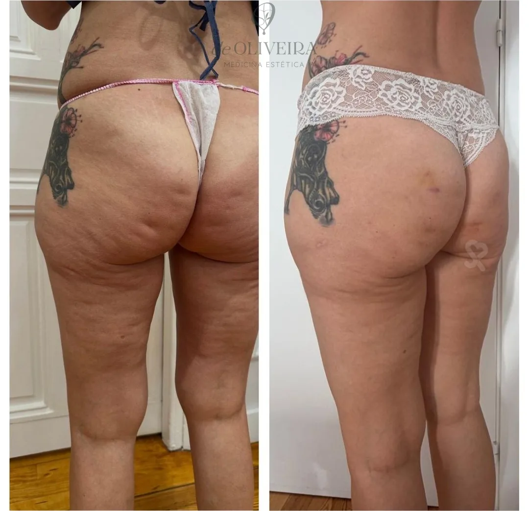 Antes y después en glúteos, en deOLIVEIRA | Clinic (Madrid)