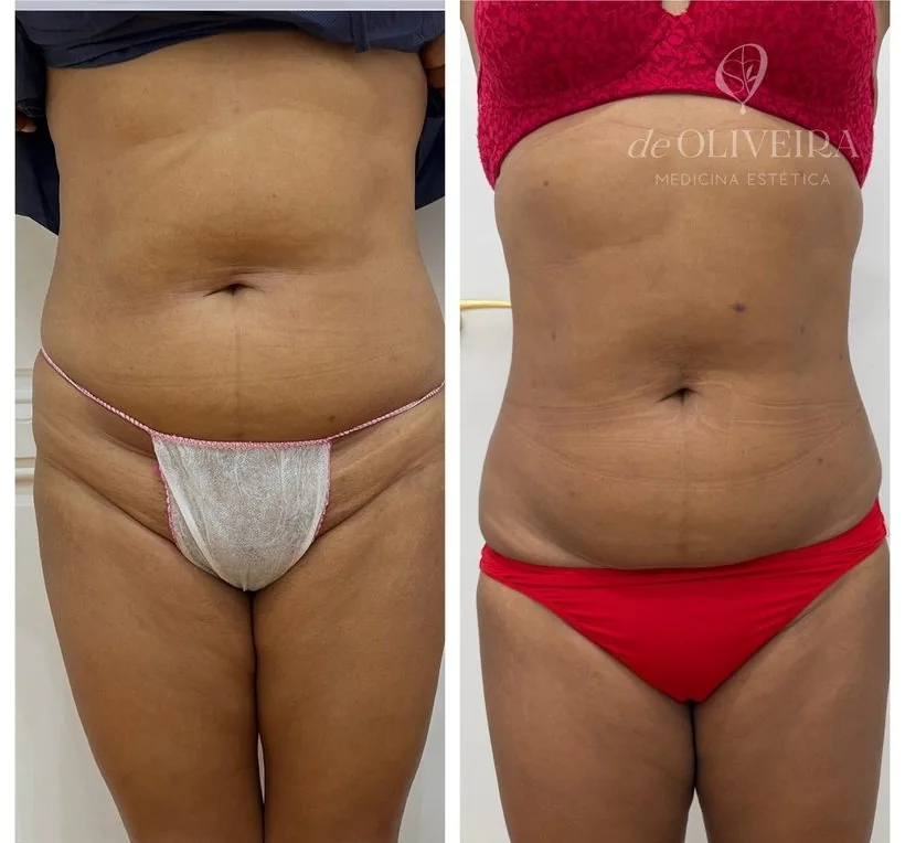 Resultado de grasa localizada en abdomen — deOLIVEIRA Clinic