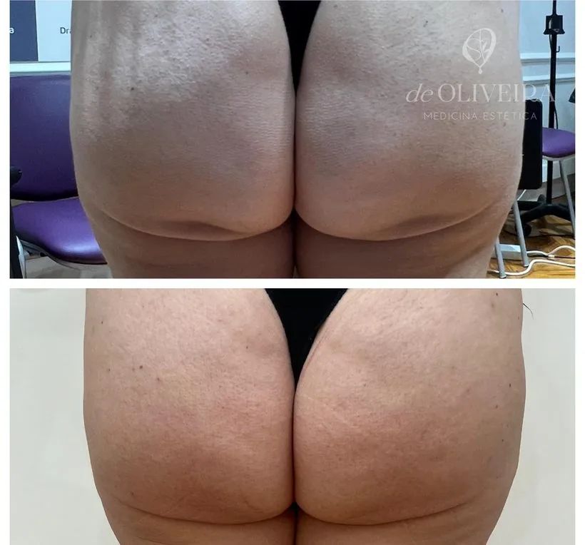 Resultado en glúteos — deOLIVEIRA Clinic