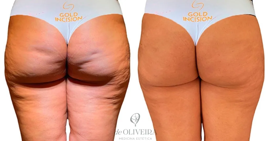 Antes y después de celulitis con hoyuelos tratada con GoldIncision en glúteos, en deOLIVEIRA | Clinic