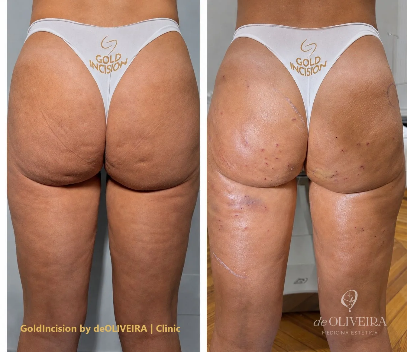 Antes y después del tratamiento de celulitis con GoldIncision en glúteos, en deOLIVEIRA | Clinic