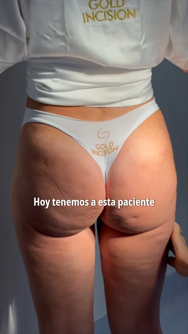 Resultado en vídeo de caso real, en deOLIVEIRA | Clinic (Madrid)