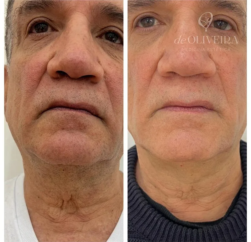 Antes y después de lipoláser de papada