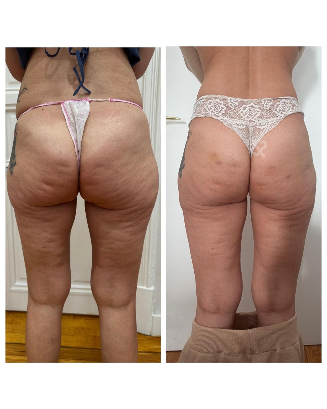 Antes y después — Remodelación corporal