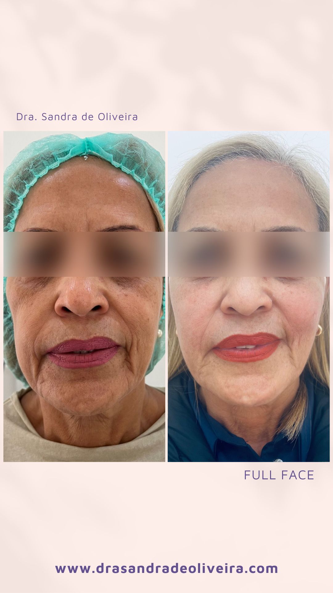 Antes y después — Full Face