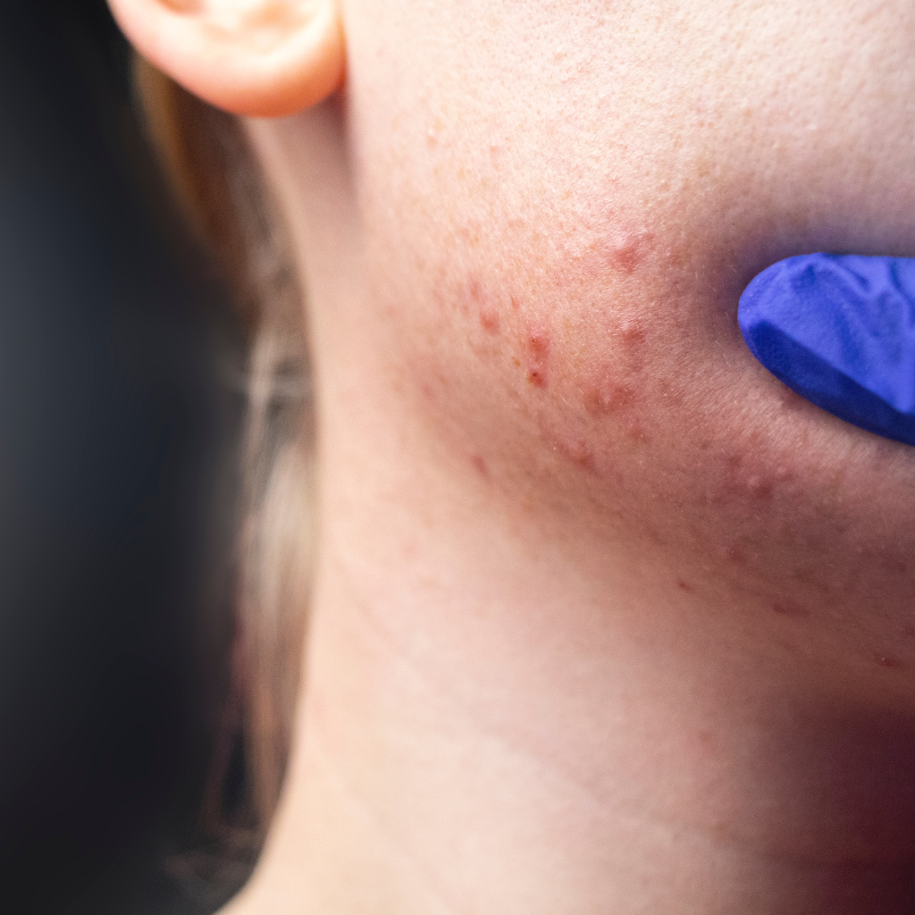 Combatir el acné con Radiofrecuencia nanofraccionada facial, pros y contras