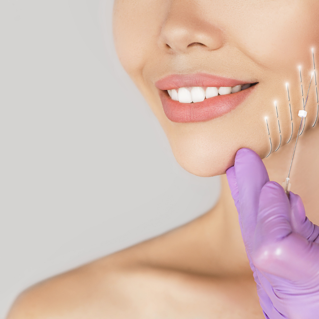 Lifting Facial con Hilos Aptos