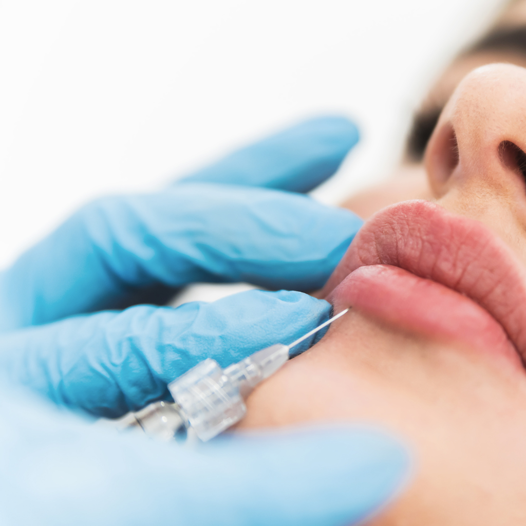 ¿Tiene efectos secundarios el ácido hialurónico en los labios?